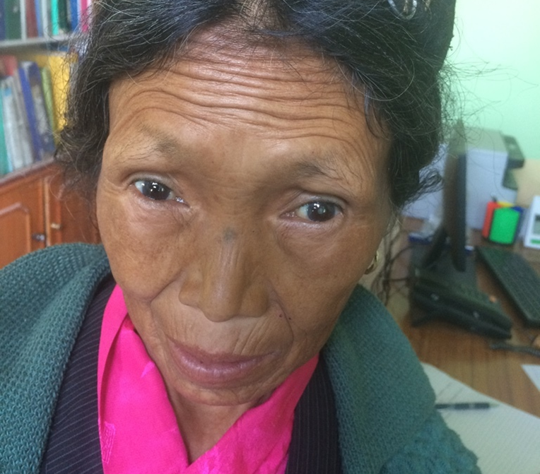 Nesum before her surgery with a visible cataract in her right eye