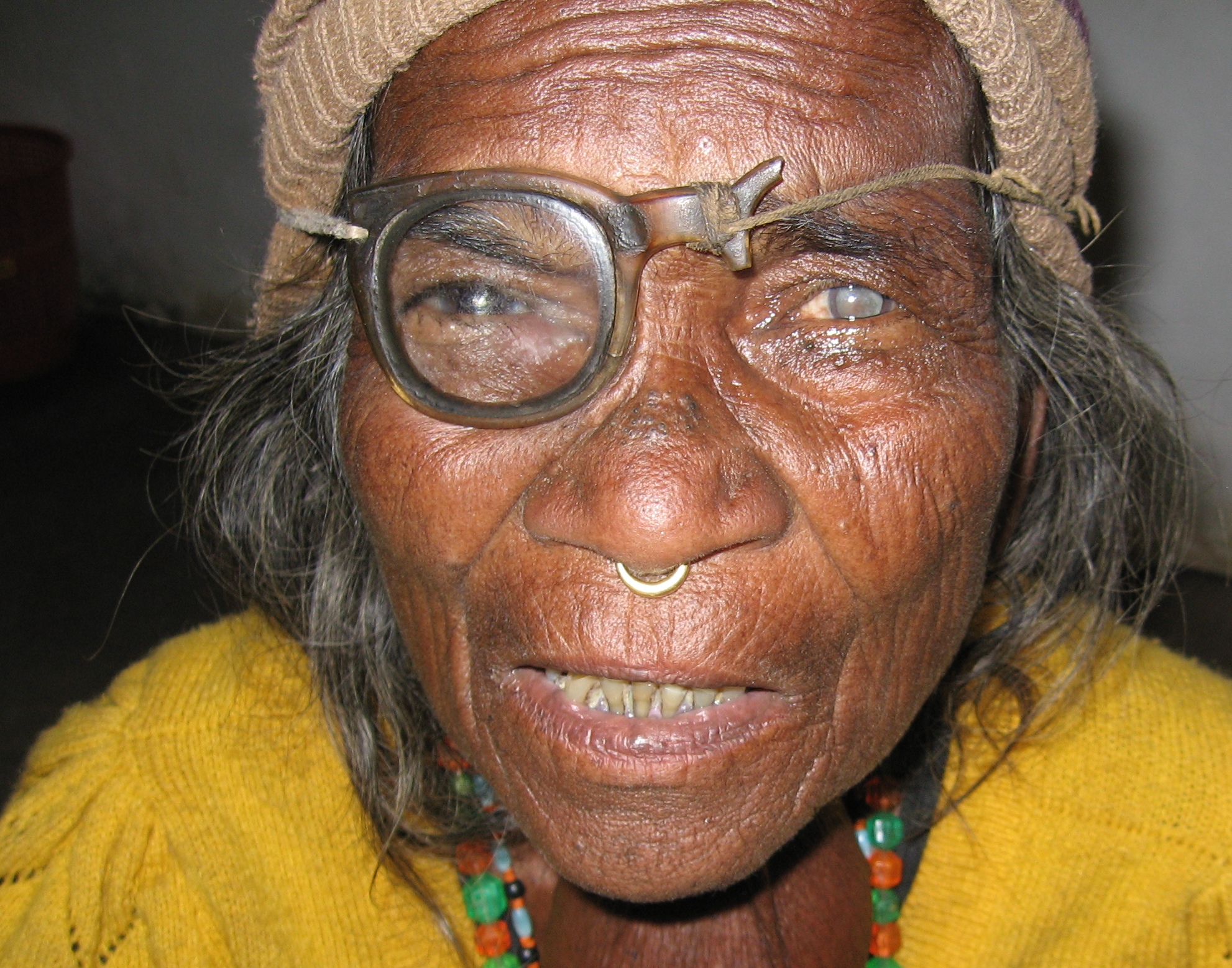 This Nepali woman was seen at a recent Seva eye camp in Doti. Notice her broken glasses and mature cataract.