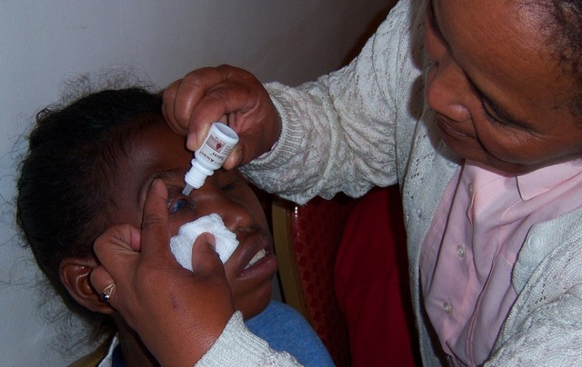 A young girl in Madagascar receives eye drops donated by Alcon Canada