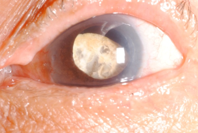 cataract eye Cambodia