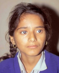 Nepali teenage girl with bilateral cataracts Seva Canada