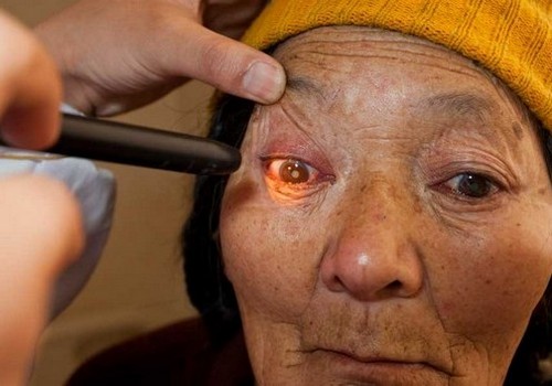 One of three sisters blinded by cataract has her eyes examined prior to surgery. Photo by William Jans