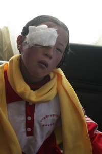 after eye surgery Tibetan girl at Seva eye camp